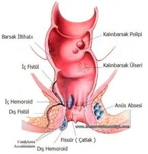 Basur - Hemoroid